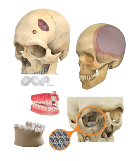 Biodegradable Implant