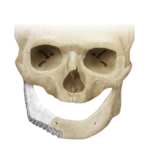 Patient Specific Implant